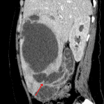 Acute cholecystitis complicated by gallbladder perforation into the liver (red arrow) with formation of a large hepatic abscess.