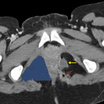 Left perianal fistulae (red arrow) and abscess (yellow arrow) partially obscuring fat in the left ischiorectal space. The right ischiorectal space (blue shaded area) appears normal on this axial CT slice.
