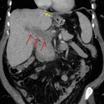 Portal vein thrombosis: expanded portal vein with internal hypodensity and surrounding fat stranding (red arrows). Note that there is contrast in the hepatic veins (yellow arrow) so there would already be contrast in the portal veins if they were patent.