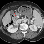 Nonocclusive thrombus in the main portal vein (red arrow).