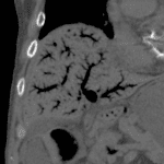 Extensive hepatic portal venous gas. Notice the multiple orders of branching which is not typical for pneumobilia.