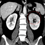 Patchy enhancement of the upper pole and interpolar region of the left kidney (circled in red) concerning for pyelonephritis.