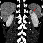 Red arrow: small area of patchy hypoenhancement in the upper pole of the left kidney which may represent pyelonephritis.