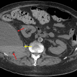 Large right retroperitoneal hematoma (red arrows) with a hematocrit level (yellow arrows).