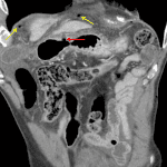 Superiorly directed gastric ulcer in the distal antrum (red arrow). Several small locules of free air in the right upper quadrant (yellow arrows).