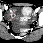 Ruptured ovarian cyst: right ovarian corpus luteal cyst (circled in red) with adjacent blood clot and lower density unclotted blood layering dependently in the pelvis.