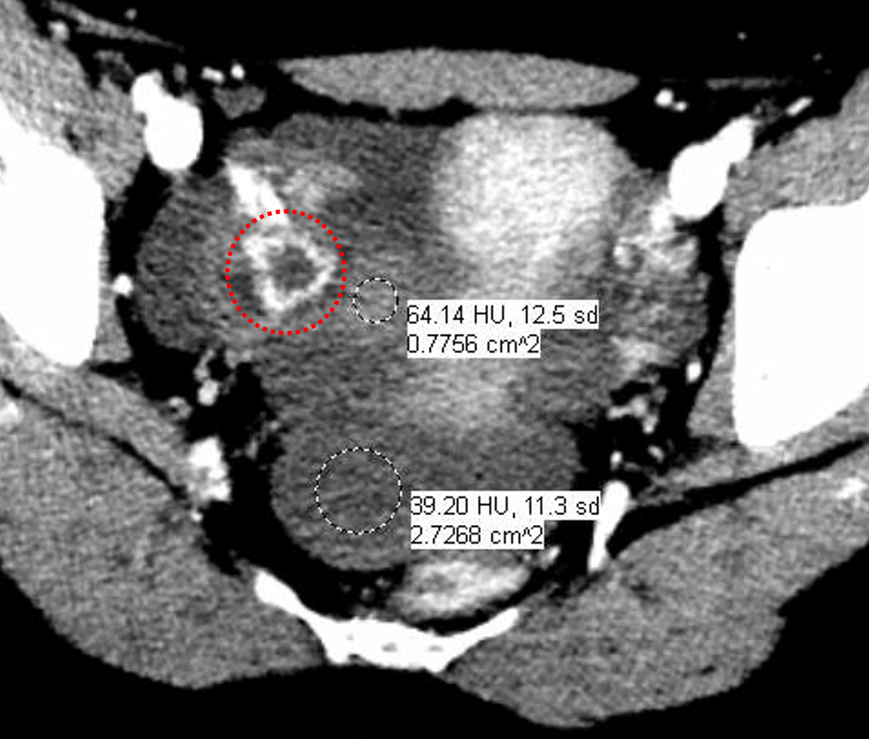 Hemorrhagic Ovarian Cyst Mri