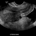 Contemporaneous ultrasound in this patient shows a moderate volume of mildly complex pelvic fluid, as shown on this midline sagittal transvaginal image.