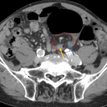 Swirled mesentery feeding the volvulized loop (circled in red) with close proximity of the ingoing (yellow arrow) and outgoing (blue arrow) segments.