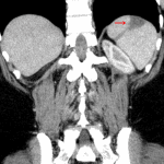 Red arrow: wedge-shaped hypodense area in the spleen extending to the capsule, consistent with splenic infarct.