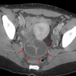 Pyosalpinx: dilated tubular structure associated with the right adnexa (red arrows) concerning for a pus-filled obstructed fallopian tube.