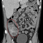 Marked inflammation of the cecum and ascending colon in this patient with typhlitis (circled in red).