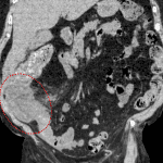 Typhlitis: inflammatory changes centered on the cecum extending to the adjacent terminal ileum and ascending colon (circled in red).