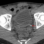 Obstructing distal left ureteral calculus (red arrow).