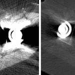 Notice how much more obvious the stone (red arrow) is on bone window (image on right) than on soft tissue window (image on left) in this patient with streak artifact from bilateral hip arthroplasties.