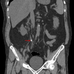 Obstructing mid right ureteral calculus (red arrow).