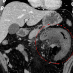 Marked mural edema of the proximal jejunum with edema in the associated mesentery (circled in red).