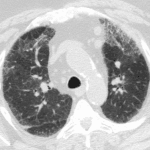 Initial chest CT in this patient shows peripheral groundglass opacities and interlobular septal thickening in a crazy paving pattern, consistent with exudative phase of ARDS, though there could be coexisting pneumonia.