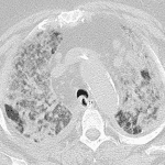 Chest CT 2 weeks later shows increased interstitial and alveolar disease with suggestion of some early reticular changes, likely recurrent exudative phase superimposed on proliferative phase.