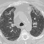 Chest CT 2 months from the initial study shows decreased opacities with residual subpleural reticulation, particularly anteriorly, with mild traction bronchiectasis consistent with fibrotic phase.