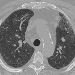 Chest CT 9 months after the initial study shows decreased, mild residual anterior subpleural reticulation with associated traction bronchiectasis.