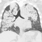 Extensive bilateral airspace consolidation with air bronchograms and subpleural sparing in this patient with diffuse alveolar hemorrhage.