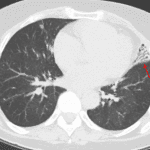 Consolidation and bronchiectasis in the lingula (red arrow) in this patient with mycobacterium avium intracellulare infection.