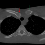 Posterior dislocation of the right sternoclavicular joint with clear posterior offset of the right clavicular head (red arrow) relative to the left (green arrow).