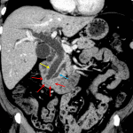 Soft tissue mass in the region of the ampulla (red arrows) with associated biliary (yellow arrow) and pancreatic (blue arrow) duct dilation.
