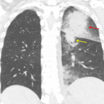 Angioinvasive aspergillosis: masslike areas of consolidation with surrounding groundglass halos in the left upper (red arrow) and left lower (yellow arrow) lobes.