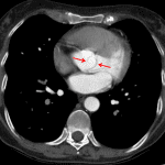 Fishmouth appearance of the aortic valve (red arrows), which can be a challenging call to make prospectively on a non-gated CT.