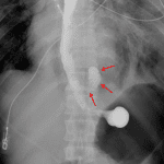 Subsequent esophagram in this patient shows contrast material leaking from the left aspect of the distal thoracic esophagus (red arrows).