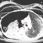 Complete right mainstem bronchial avulsion (red arrow) with dependent collapse of the right lung. Note the large amount of pleural gas despite the correctly placed right thoracostomy tube (yellow arrow).