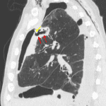 Bronchopleural fistula: linear area of cavitation in the anterior aspect of the right upper lobe (red arrows) with a direct communication to the pleural space (yellow arrow).