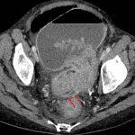 Fluid-filled track that appears to extend from the sigmoid colon to the region of the vaginal apex, concerning for a colovaginal fistula (red arrows).