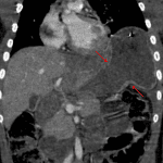 Traumatic left hemidiaphragm rupture with herniation of much of the stomach through the defect. Note waisted narrowing of the stomach where it herniates through the defect (red arrows).