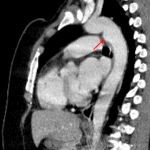 Ductus diverticulum: small bump along the anteromedial aspect of the aortic isthmus (red arrow) without adjacent hemorrhage or stranding.