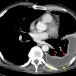 Empyema: split pleura appearance with fluid separating the thickened visceral (red arrows) and parietal (yellow arrows) pleural layers.