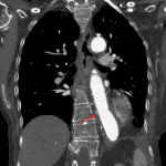 Focal contrast leakage along the medial aspect of the aorta along the proximal margin of the graft concerning for type 1A endoleak.