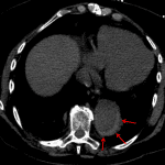Intramural hematoma seen as a hyperdense crescent in the aortic wall on precontrast images (red arrows).