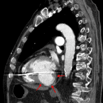 Outpouching from the inferior wall of the left ventricle with peripheral calcification and mural thrombus (red arrows), most consistent with a false aneurysm.