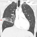 Lobar pneumonia: consolidation in the lateral segment of the right middle lobe with associated volume loss in the right middle lobe.