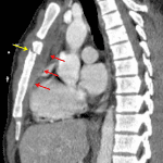 Sternal fracture (yellow arrow) with overlying soft tissue hematoma and subjacent mediastinal hematoma (red arrows).