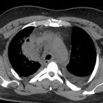 Right upper lobe abscess with adjacent mediastinal fat infiltration. Notice how poorly defined the mediastinal vessels are, including the aortic arch.