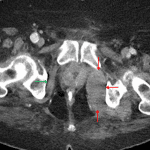 Asymmetric enlargement of the left obturator internus muscle (red arrows) relative to the right (green arrow) concerning for intramuscular hematoma.