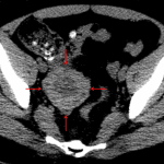 Enlarged right ovary with a thick, hyperdense rim (red arrows) and peripheralization of follicles.
