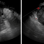 Subsequent ultrasound in this patient shows the enlarged ovary without evidence of blood flow on color Doppler (image to the right) or evidence of either venous or arterial flow on spectral Doppler tracings (not shown).