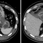 Focus of active hemorrhage in a hematoma adjacent to the pancreatic laceration, which grows between arterial (on left) and delayed (on right) phase images.