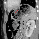 Perforated gastric ulcer along the lesser curvature (red arrow).