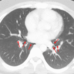 Pneumomediastinum with bilateral central interstitial emphysema (red arrows).